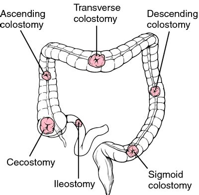 stoma medical term.